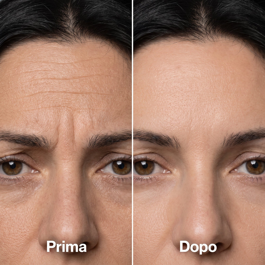 Prima e dopo: rughe della fronte distese